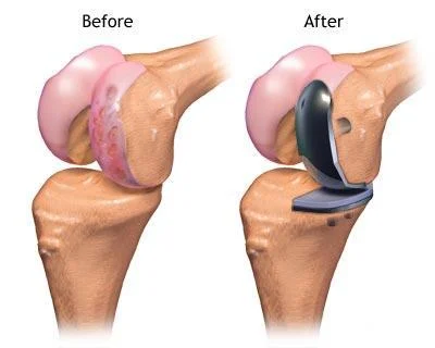 Best Surgeon For Unicondylar Partial Knee Replacement In New Delhi